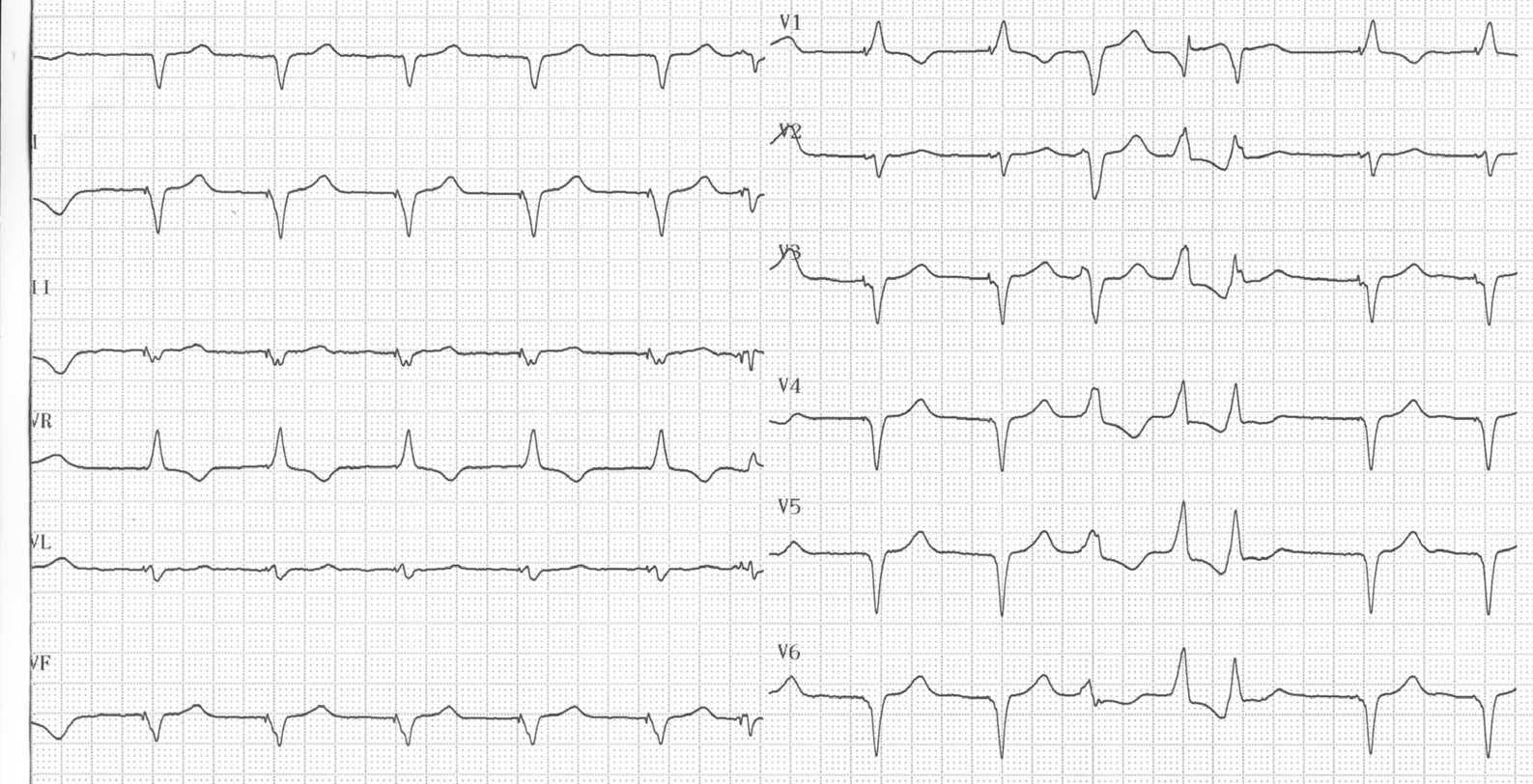 trace-8-5-ecg2