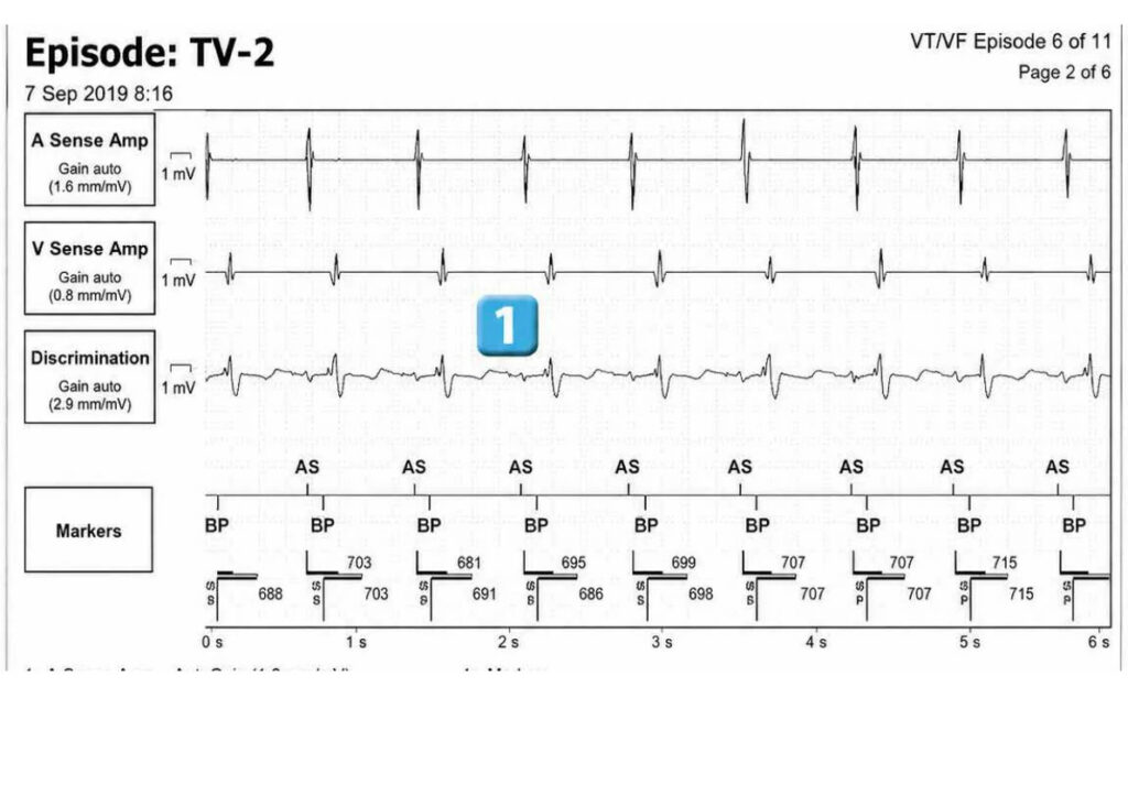 Accélération d’une TV par une stimulation anti-tachycardique et seuil de défibrillation élevé : tracé de DAI Abbott (EGM)