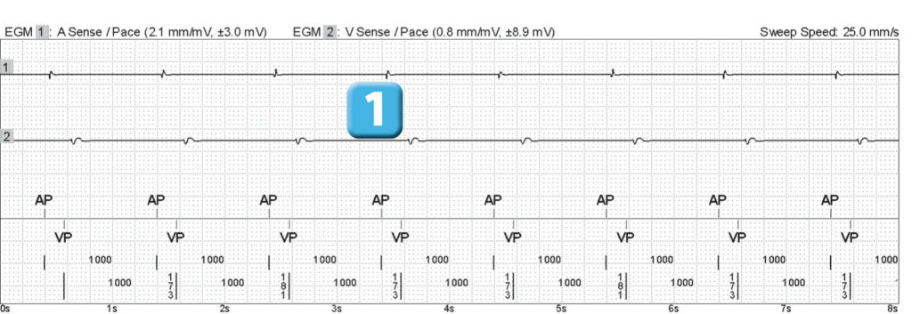 Episode de fibrillation ventriculaire et seuil de défibrillation élevé : tracé de DAI Abbott (EGM)