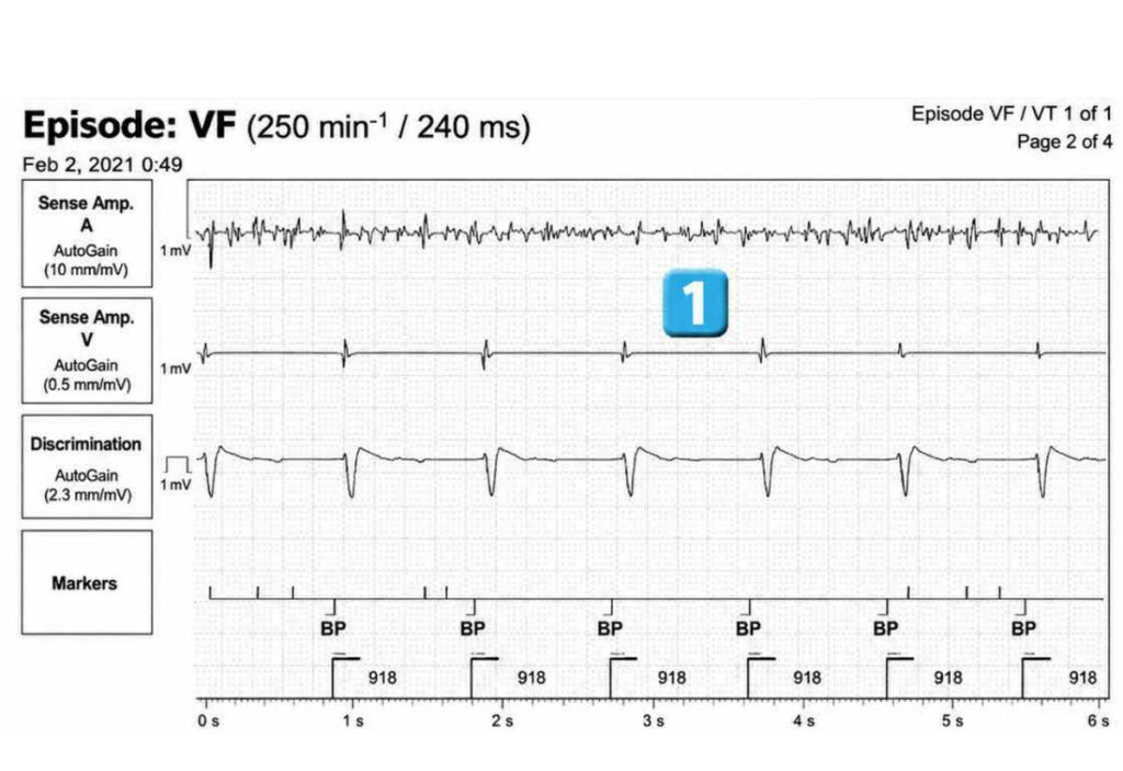 Dysfonction de sonde et algorithme DynamicTx™ : tracé de DAI Abbott (EGM)