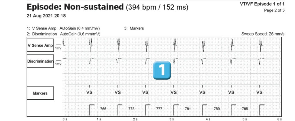 Surdétection d’un signal 50 Hz – Gallant CRT-D : tracé de DAI Abbott (EGM)