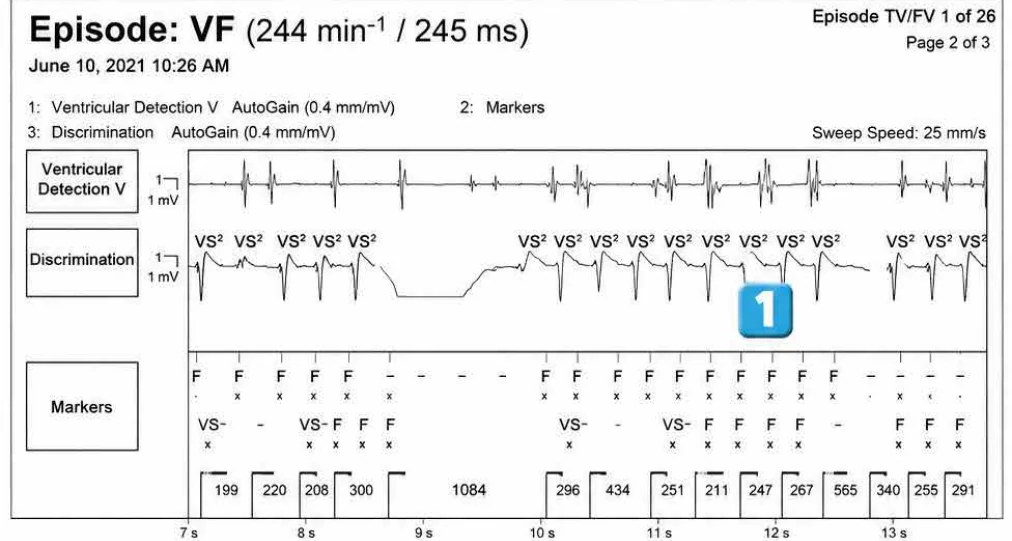 Chirurgie et utilisation du bistouri électrique : tracé de DAI Abbott (EGM)