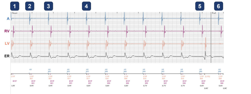 Ambulatory PaceSafe LV threshold test: Boston Scientific CRT tracing (EGM)