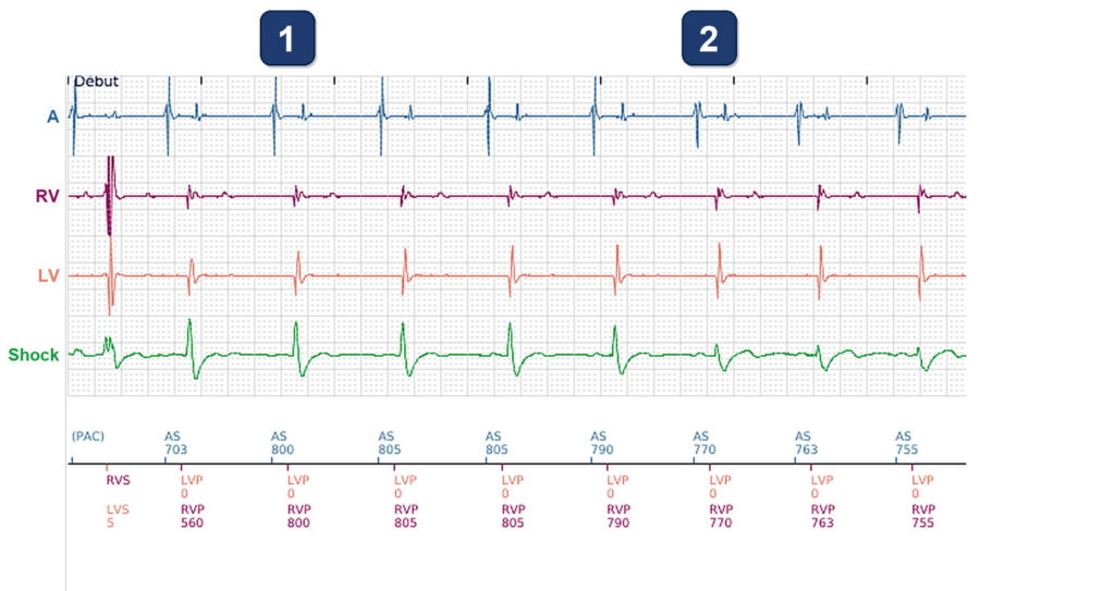 BiV markers with changing far-field morphology: Boston Scientific CRT tracing (EGM)