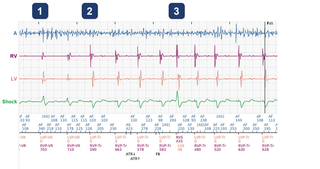 BiV Trigger in AF, and the same patient 15 months later: Boston Scientific CRT tracing (EGM)