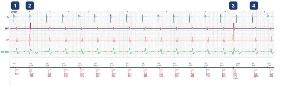 CRT-D in sinus rhythm, BiV pacing 89%: Boston Scientific CRT tracing (EGM)