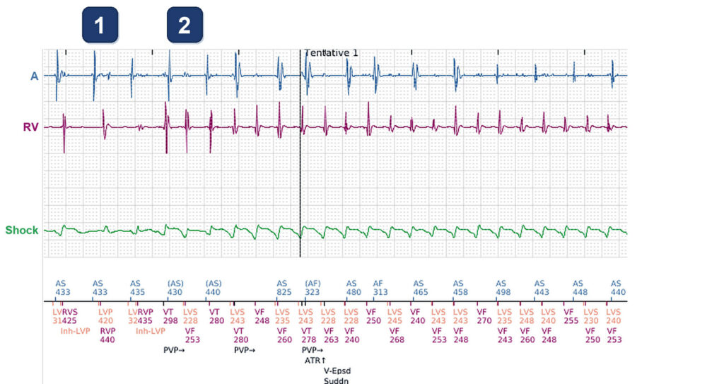 CRT-D shock: and what about the LV channel?: Boston Scientific CRT tracing (EGM)