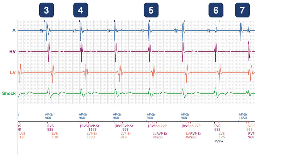 CRT drop and low-amplitude atrial events: Boston Scientific CRT tracing (EGM)