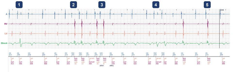 CRT drop in a patient with atrial ectopy: Boston Scientific CRT tracing (EGM)