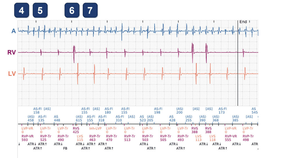 CRT-P in AF: two different pacing percentages: Boston Scientific CRT tracing (EGM)