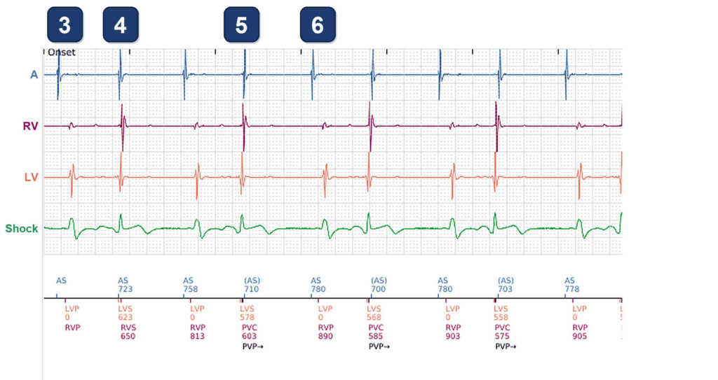 CRT pacing alert at 57%, and 2 years later: Boston Scientific CRT tracing (EGM)