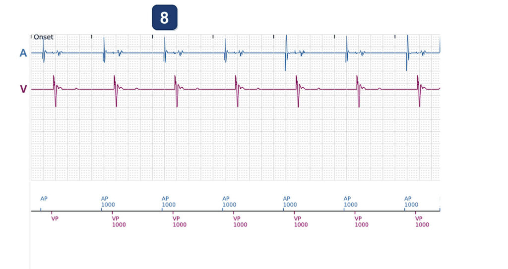 CRT with a dual chamber pacemaker using LBBAP: Boston Scientific CRT tracing (EGM)