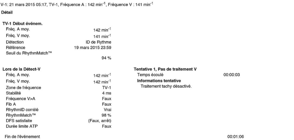 Exercise: sinus tachycardia in the VT-1 zone: Boston Scientific CRT tracing (EGM)