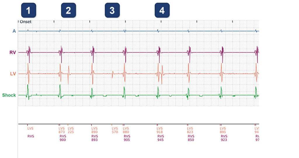 Extra LV sensed events in a CRT-D programmed VVI 40: Boston Scientific CRT tracing (EGM)
