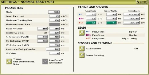 Programmer screen, Settings – Normal Brady/CRT (an example): under LEADS the pacing and sensing configuration of each lead is set; there the LV sensing vector can be changed, and LV sensing can even be switched off