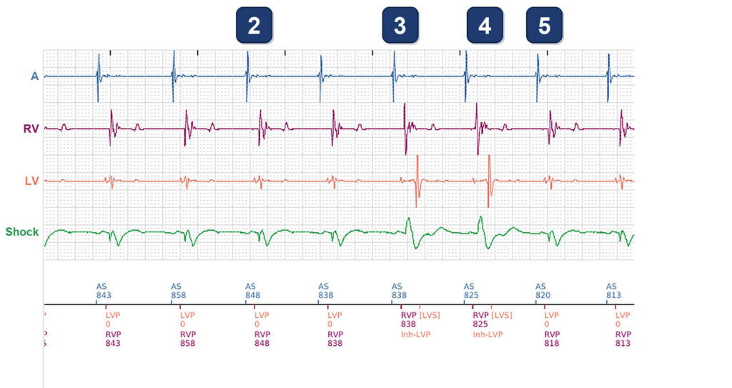 Intermittent loss of LV pacing despite 99% RV pacing: Boston Scientific CRT tracing (EGM)