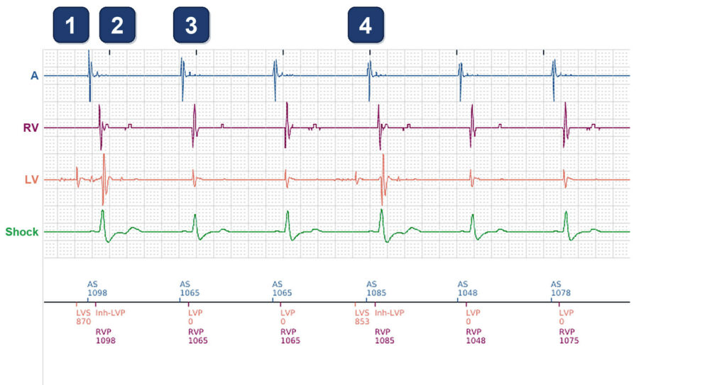 Intermittent RV-only paced beats in a RESONATE CRT-D: Boston Scientific CRT tracing (EGM)