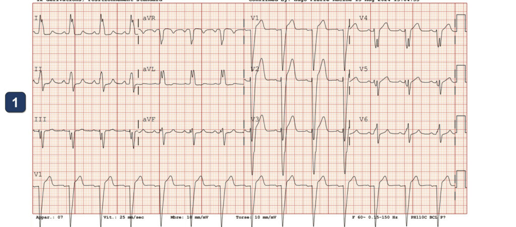 LOT-CRT with a Boston CRT-P: Boston Scientific CRT tracing (EGM)