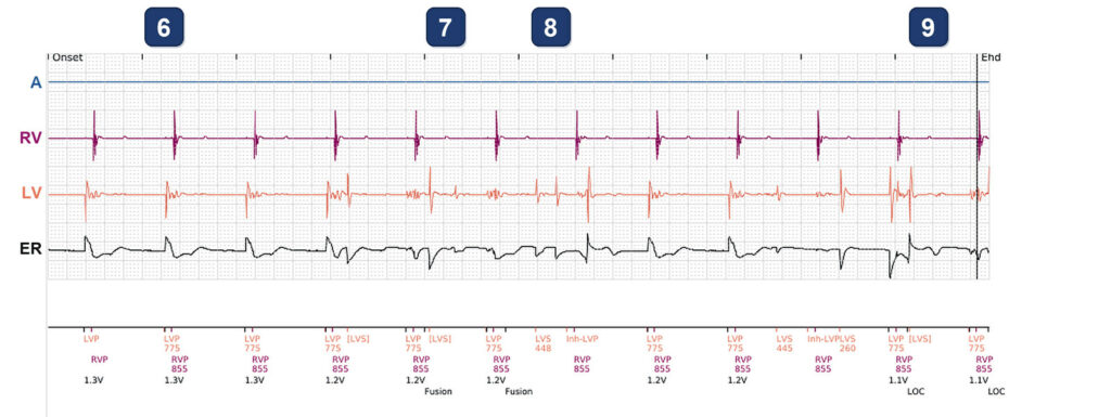 LV impedance alert and an odd PaceSafe LV test: Boston Scientific CRT tracing (EGM)
