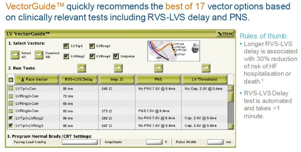 VectorGuide (Boston Scientific programmer) tests the vectors of a quadripolar LV lead: RVS-LVS delay, impedance, phrenic nerve stimulation (PNS) and LV threshold for each one. Every vector has its own impedance: 292 to 547 Ω in this example, where LVTip1>>LVRing2 measures less than LVRing4>>Can; in this patient it measures about three times more