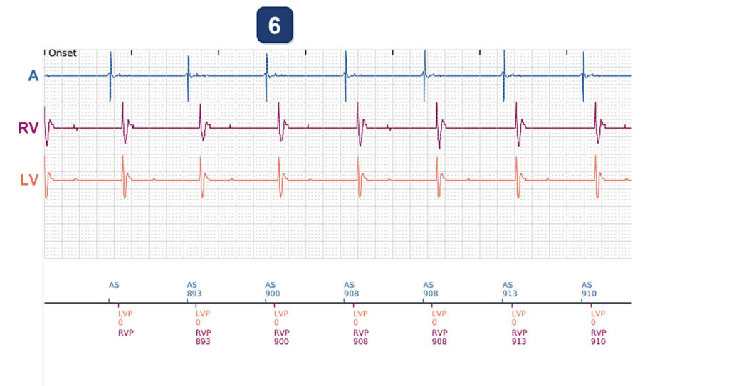 LV impedance jump after an office visit: Boston Scientific CRT tracing (EGM)