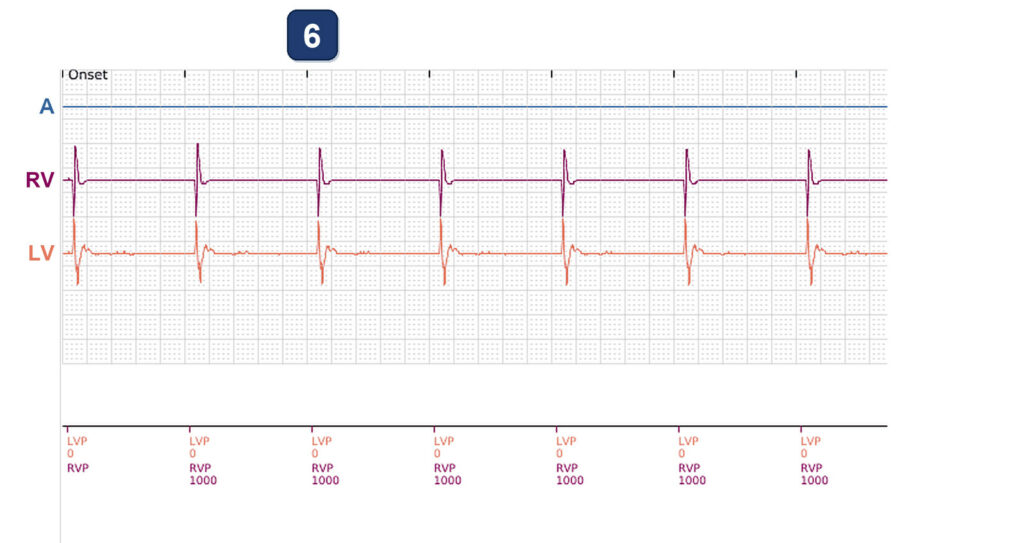 LV impedance out-of-range alert near battery end of life: Boston Scientific CRT tracing (EGM)