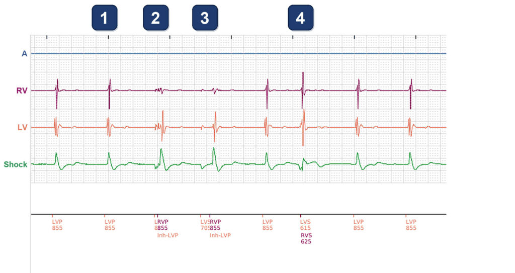 LV-only pacing with oversensing on the LV and on the RV channel: Boston Scientific CRT tracing (EGM)
