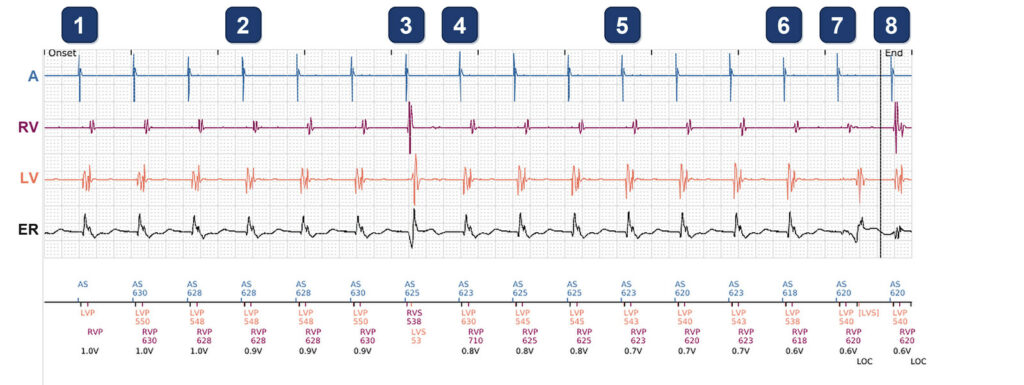 PaceSafe LV test with an unexpected beat: Boston Scientific CRT tracing (EGM)