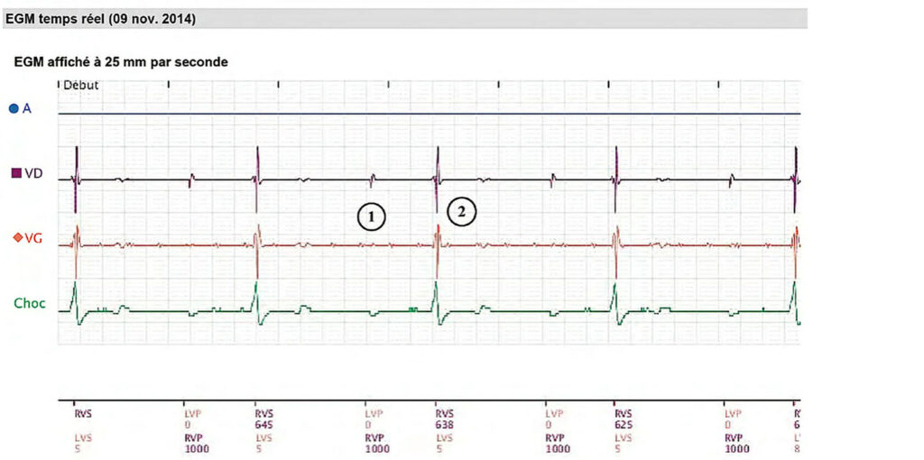 Remote real-time EGM in a dialysis patient: Boston Scientific CRT tracing (EGM)