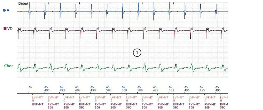 Sinus tachycardia, Wenckebach and pro-arrhythmia: Boston Scientific CRT tracing (EGM)