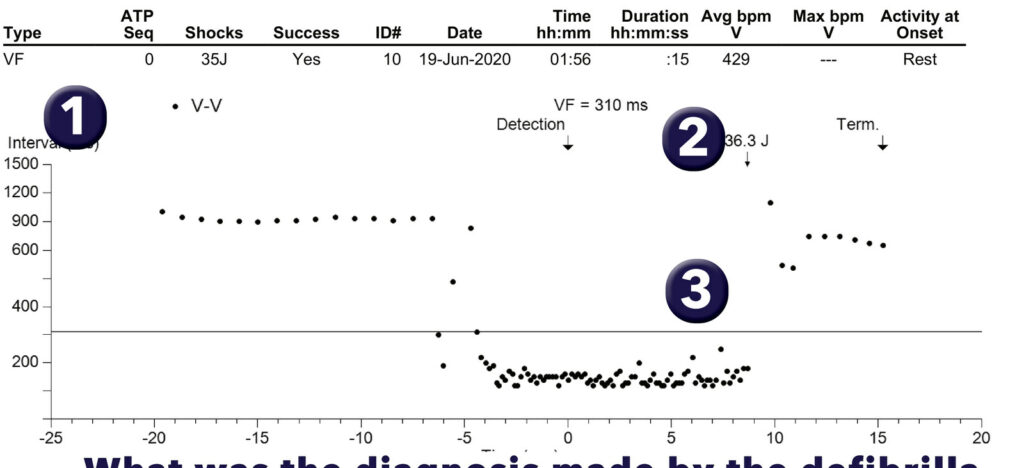 Défibrillateur simple chambre et limite V.TSV : tracé de DAI Medtronic (EGM)